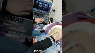 How to examine Appendix and bowel by ultrasound بكل سهوله هنفحص الزايده والمعده والأمعاء بالسونار [upl. by Nama]