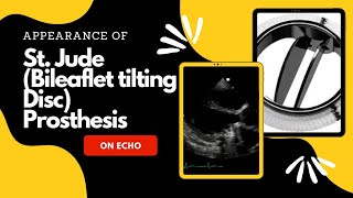 St Jude Mitral Prosthesis on Echocardiography [upl. by Elatnahc]