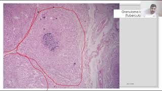 Aula prática sobre inflamação crônica e crônica granulomatosa [upl. by Ikcir]