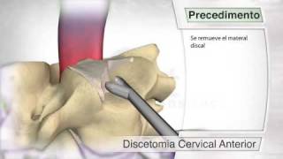 Disectomía cervical anterior [upl. by Perren]