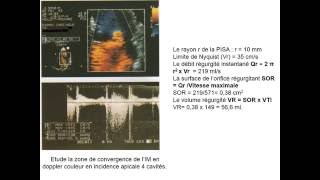 CARDIOLOGIE INSUFFISANCE MITRALE [upl. by Agni346]