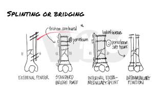 Principles of Fracture Fixation  Orthopedic Basics [upl. by Eilegna932]