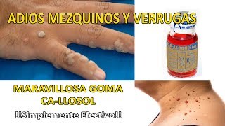 how to eliminate warts natural elimina mezquinos [upl. by Anneehs25]