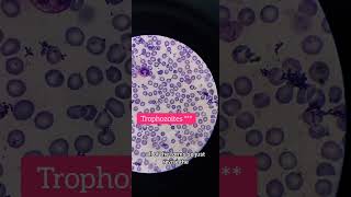 MP slide Plasmodium vivax on oil immersion 100× laboratory hematology [upl. by Helse]