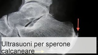 Recensioni sullefficacia della terapia ad onde durto per speroni calcaneali [upl. by Jaime117]