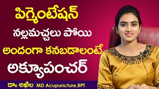 Hyper Pigmentation Natural Remedies in Telugu  Glowing Skin  Acupuncture Telugu  Dark Skin Patch [upl. by Mercedes888]