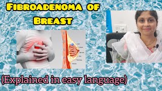 Fibroadenoma of Breast explained in simple language  Female Health  Treatment [upl. by Lanuk]