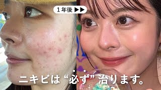 本気で治したい人だけ見て。ニキビ地獄から､毛穴ゼロ＆たまご肌になった5つの方法🥚 [upl. by Lorenzo]