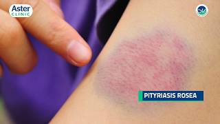 Dr Srinivasa Munivenkatappa talks about Pityriasis Rosea [upl. by Paten417]