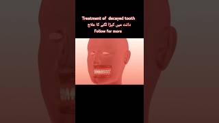 Dant min keeda ka ilaj  decayed tooth  dental viral shorts [upl. by Aicertal]