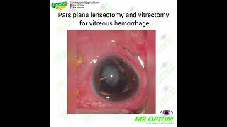 pars plana lensectomy and vitrectomy for vitreous hemorrhage [upl. by Kauffmann]