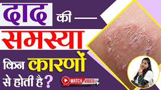 Fungal Infection क्या है और ये किन कारणों से होता है  Bharat Skin Clinic  Dr Kanchan Singh [upl. by Allerbag311]