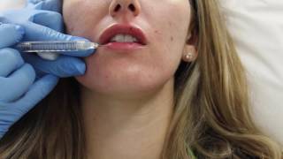 Juvederm lip filler injection by Dr Shaun Patel in Miami Florida [upl. by Senoj750]