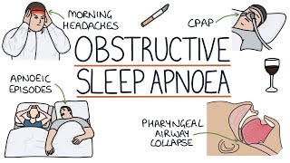 Obstructive Sleep Apnoea [upl. by Naujuj388]