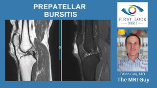 Prepatellar Bursitis [upl. by Notserp]