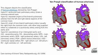 Truncus Arteriosus Imaging [upl. by Anifad]