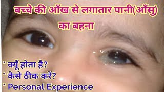 नवजात शिशु की आँख से पानी या आँसू आना। Watery Eyes in babies  Blocked Tear Duct in Babies [upl. by Lazar]