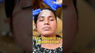 Cosmelan Peel to Treat Melasma  DrPooja Kasana [upl. by Ayela966]