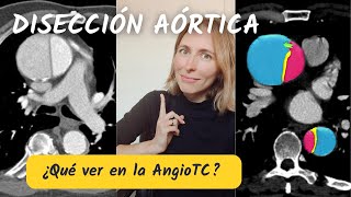 4 hallazgos clave en la DISECCIÓN AÓRTICA El que sabe lo que busca lo encuentra [upl. by Anamor]