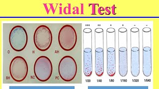 التشخيص المعملى لحمى التيفوئيد Lab Diagnosis of Typhoid Fever [upl. by Liberati]