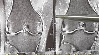 CASO DE LESÃO DO LCM LIGAMENTO COLATERAL MEDIAL [upl. by Olympe742]