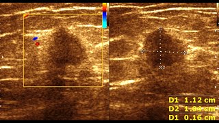 Breast Carcinoma  Fibroadenoma Breast  Benign Vs Malignant Breast Masses [upl. by Marentic]