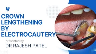 USE OF ELECTROCAUTERY FOR CROWN LENGTHENING [upl. by Girhiny]