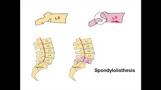 Spondylolisthesis [upl. by Willow]