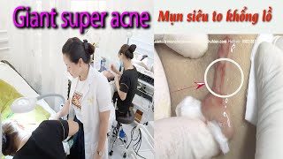 Acne treatment reputation effective at Hien Van Spa379 [upl. by Noimad]