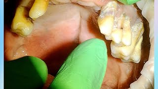 Severe Periodontal Disease Tartar Calculus with Extractions [upl. by Mitzl]