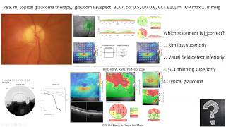 Lecture Using OCT as an Approach to Diagnose Glaucomatous and Other Optic Neuropathies [upl. by Cida]