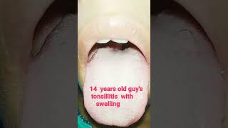 Swollen Tonsil  tonsillitis  shorts [upl. by Mccurdy]