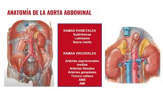 Aneurisma Aórtico Abdominal Roto [upl. by Hars]