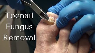 Toenail Fungus Removal  How to Cut Toenail Fungus [upl. by Richarda]