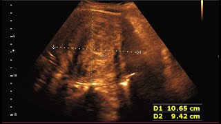 Sonographic prediction of a large intramural fibroid [upl. by Ettesus550]