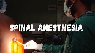 How to give spinal anesthesia  LEARN IN 1 MINUTE [upl. by Ecnaret]