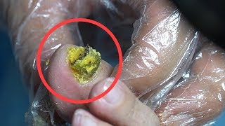 TOP MEDICAL PEDICURE PODIATRY 16  disgusting foot fungus nails clipping [upl. by Flessel]