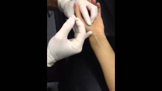 Opponens Pollicis Dry Needling [upl. by Irolam]