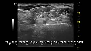 상지 마취를 위한 Ultrasound Guided Interscalene Brachial Plexus Block [upl. by Heeley938]