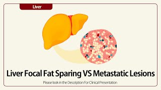 Linear EUS Liver Focal Fat Sparing [upl. by Yrtneg686]