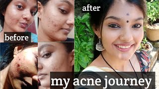 acne peel ചെയ്തപ്പോൾ എനിക്ക് സംഭവിച്ചത്acne journeymy experience acneproneskinitsmeaparna [upl. by Zindman]