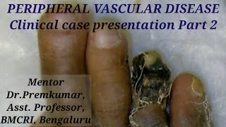 PERIPHERAL VASCULAR DISEASE Clinical case presentation Part 2 [upl. by Shana901]