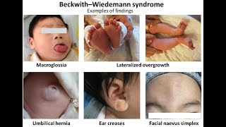 BeckwithWiedemann Syndrome Symptoms and Causes  Diagnosis  Treatment  Prevention [upl. by Aneej702]