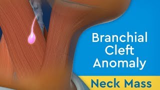 Neck Mass Branchial Cleft Anomaly [upl. by Eugene]