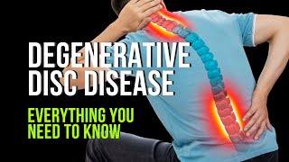 Degenerative Disc Disease  Everything You Need to Know [upl. by Eanrahc181]