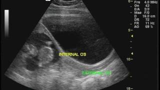 Cervix ultrasound meassurement in a pregnant patient [upl. by Sukramal]