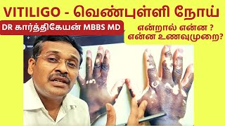 vitiligo skin problem treatment foods home remedies  வெண்புள்ளி நோய் உணவுமுறை [upl. by Atiram]