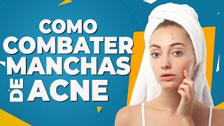 Como Combater Manchas de Acne  Dr Lucas Fustinoni [upl. by Johnnie]