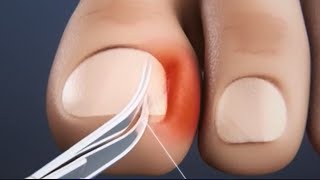 Ingrown toenail removal Treatment  Step by step health [upl. by Vogeley]