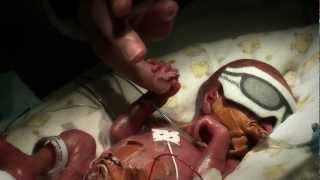 24 week premature baby  Tobys journey [upl. by Vevina232]